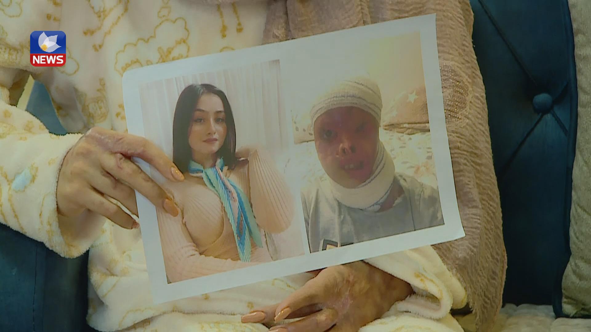 ئەو کچەی لە بەغداد بەتێزاب سوتێنرا قسە بۆ کوردسات نیوز دەکات