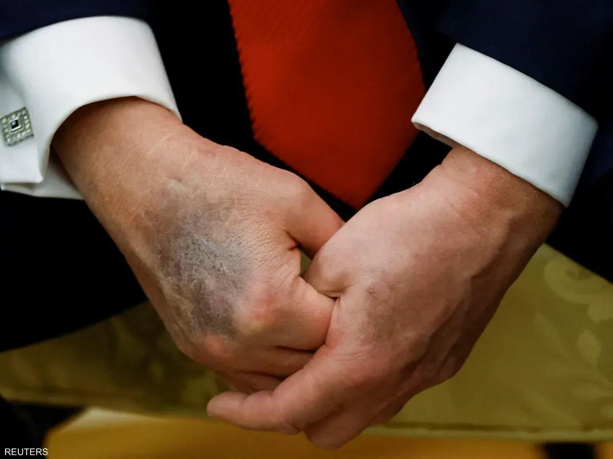 مخاوف صحية حول ترامب بعد ظهور كدمة داكنة جديدة على يده