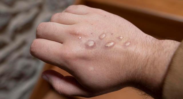 بەھۆی ئاوڵەی مەیمون باری نائاسایی لە ئوسترالیا ڕاگەیەندرا