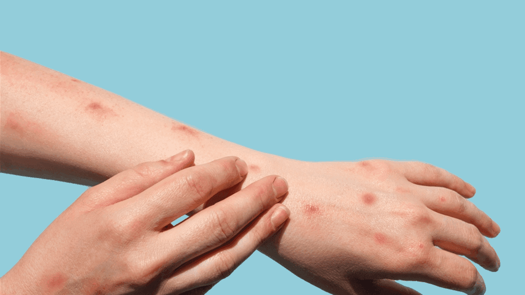 ئاماری توشبوون بە ئاوڵەی مەیمون لەسەر ئاستی جیھان لە بەرزبوونەوەدایە