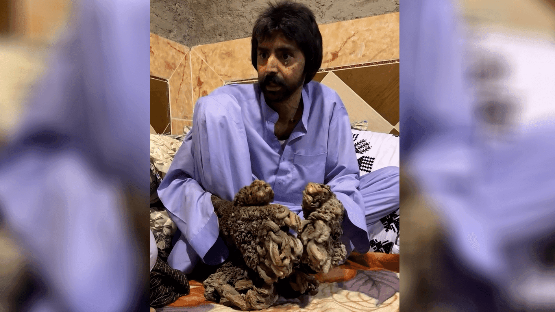 چیرۆکی ئەو پیاوەی دەست و قاچەکانی دەبن بە دار