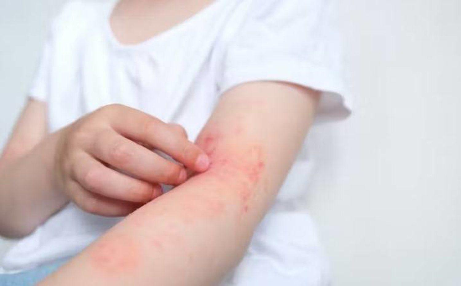 باحثون يحددون فئة الاشخاص الأكثر عرضة للإصابة بالأكزيما