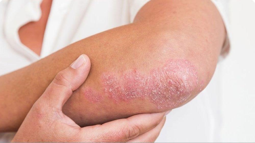 الصدفية... مرض مناعي ذاتي يؤثر على ملايين الأشخاص حول العالم