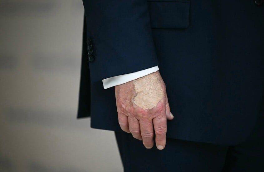 كدمة جديدة على يد ترامب اليمنى