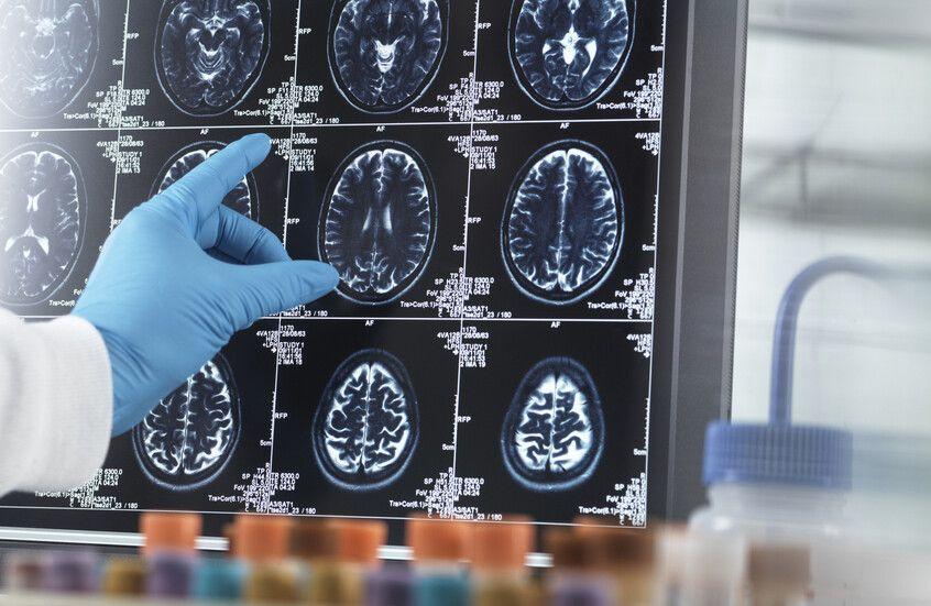 10 حقائق صادمة عن علاقة السكري بالخرف