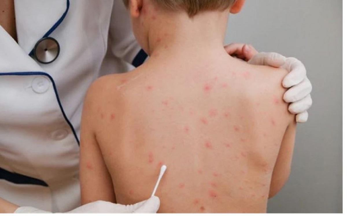 ژمارەی توشبووان بە ئاوڵەی مەیمون لە ئیسپانیا گەیشتە ٢٢٥ حاڵەت