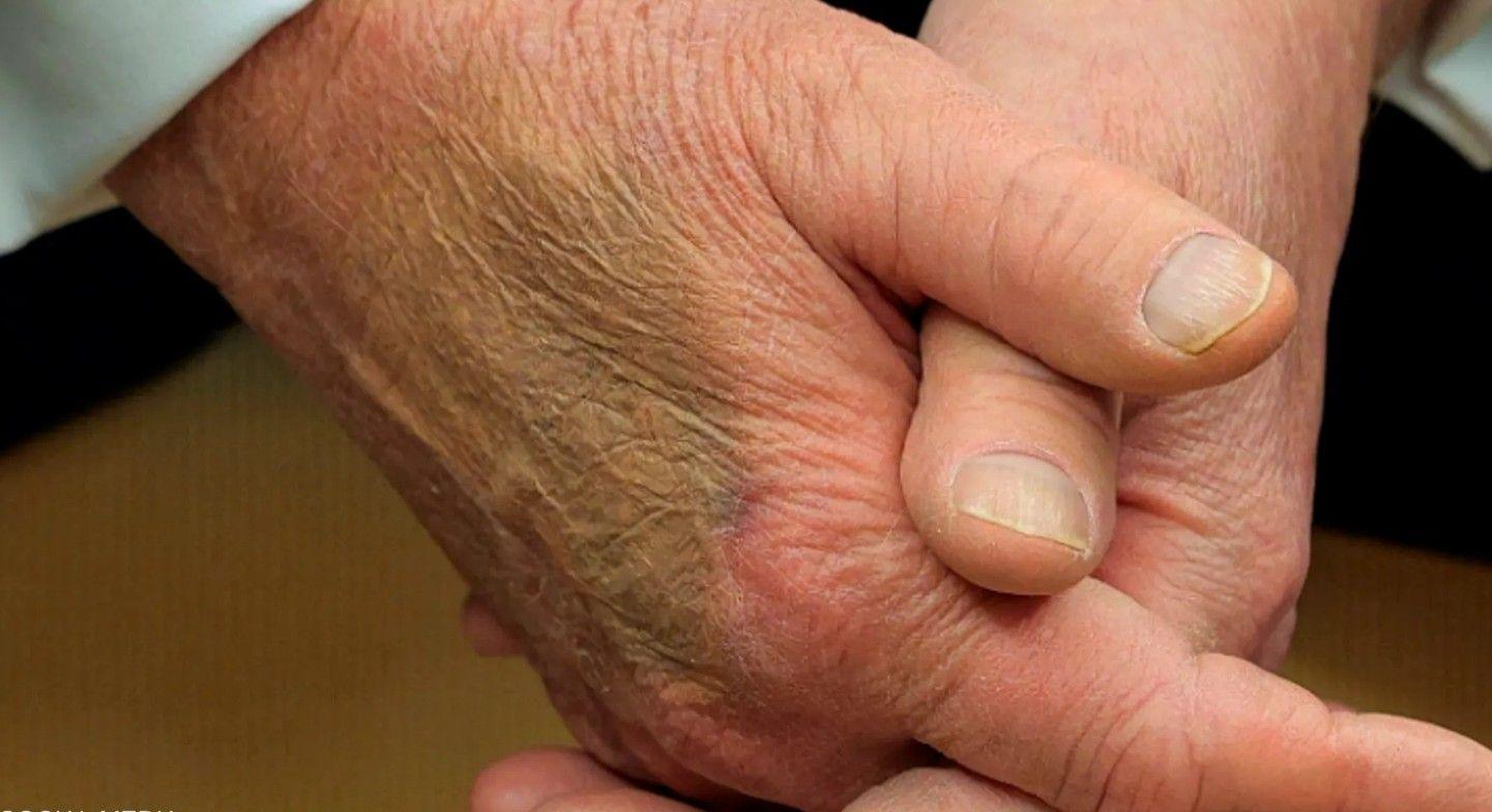 البيت الأبيض يكشف سبب الكدمة الزرقاء على يد ترامب