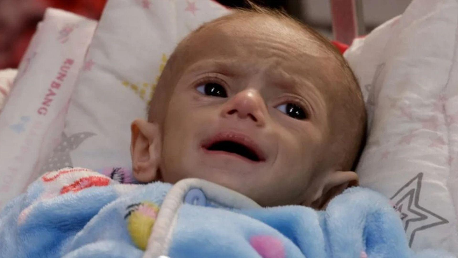 نزیکەی 60 هەزار منداڵ لە غەززە بەدەست بەدخۆراکیەوە دەناڵێنن  