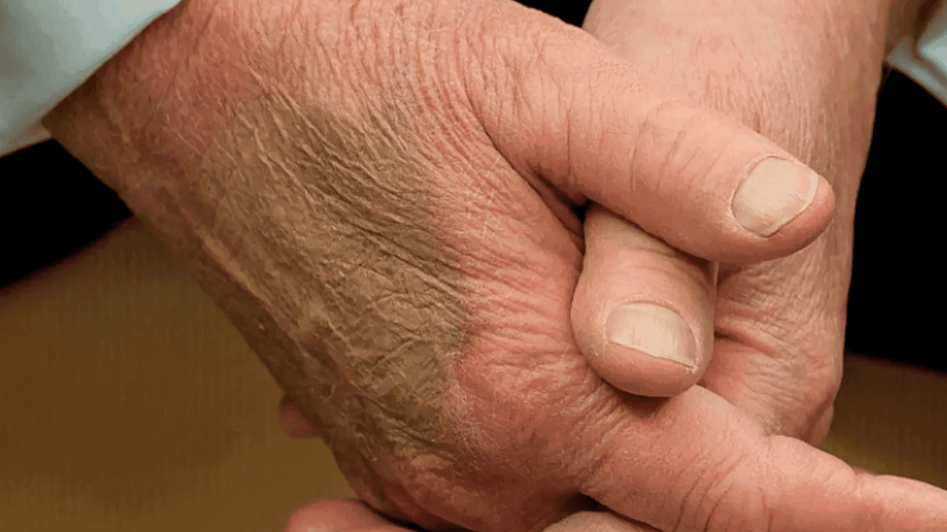 پەڵە نامۆکانی سەر دەستی ترەمپ چین؟