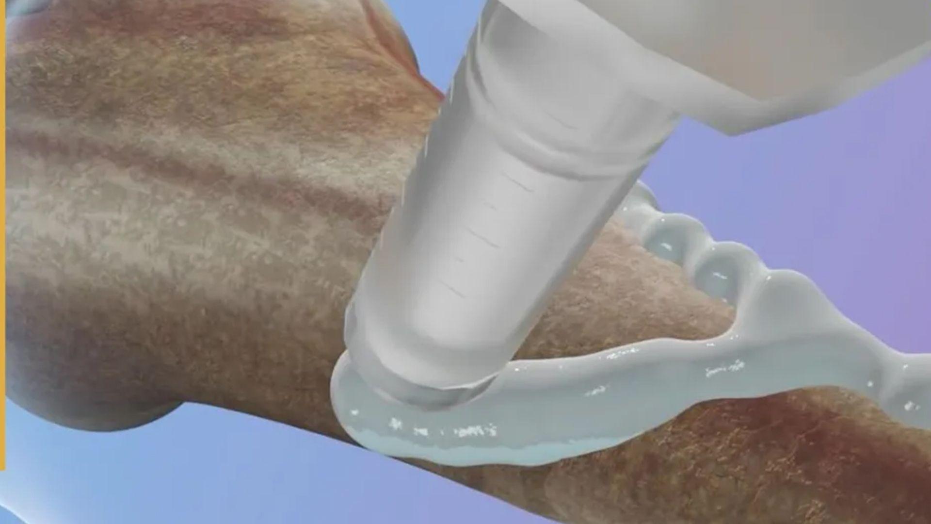 چینییەکان چەسپێکیان بەرهەمهێناوە لە سێ خولەکدا ئێسکی شکاو چاکدەکاتەوە