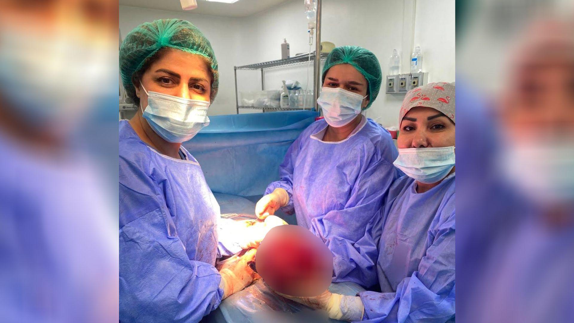 سلێمانی؛ لە نەشتەرگەرییەکی دەگمەندا گرێیەکی 20 سانتیمەتری لە منداڵدانی خانمێک دەرهێندرا