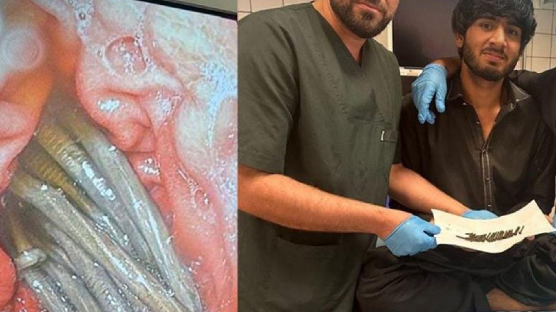 بە سەرکەوتوی 30 بزمار لە گەدەی نەخۆشێکدا دەرهێندرا